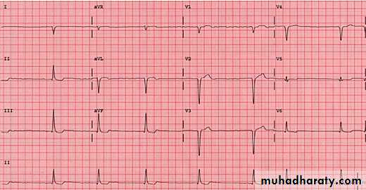 ECG
