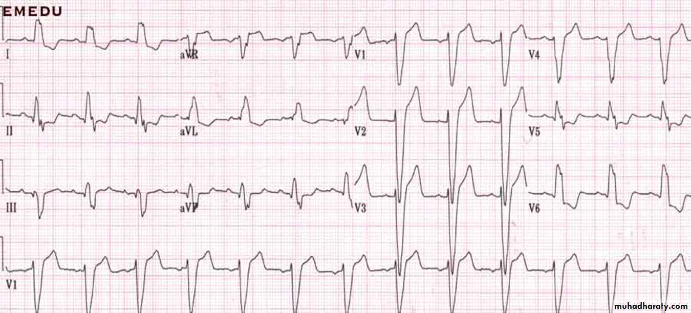 ECG