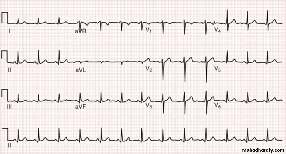 ECG