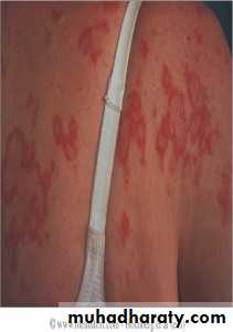 Systemic Connective Tissue Disease