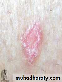 Systemic Connective Tissue Disease