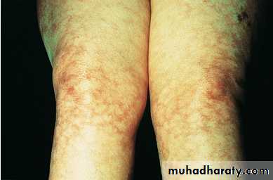 Systemic Connective Tissue Disease