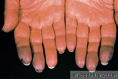 Systemic Connective Tissue Disease