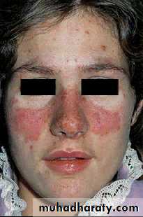 Systemic Connective Tissue Disease