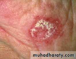 Systemic Connective Tissue Disease