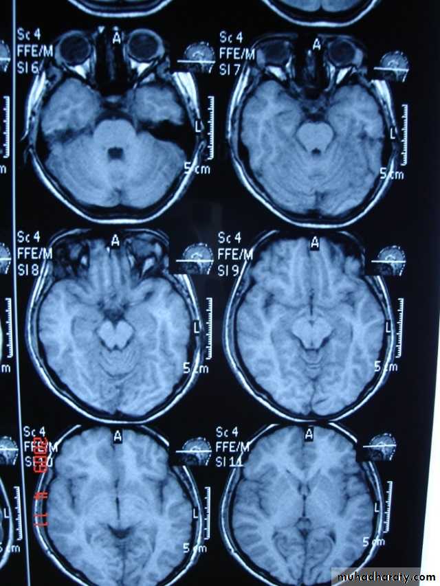MRI