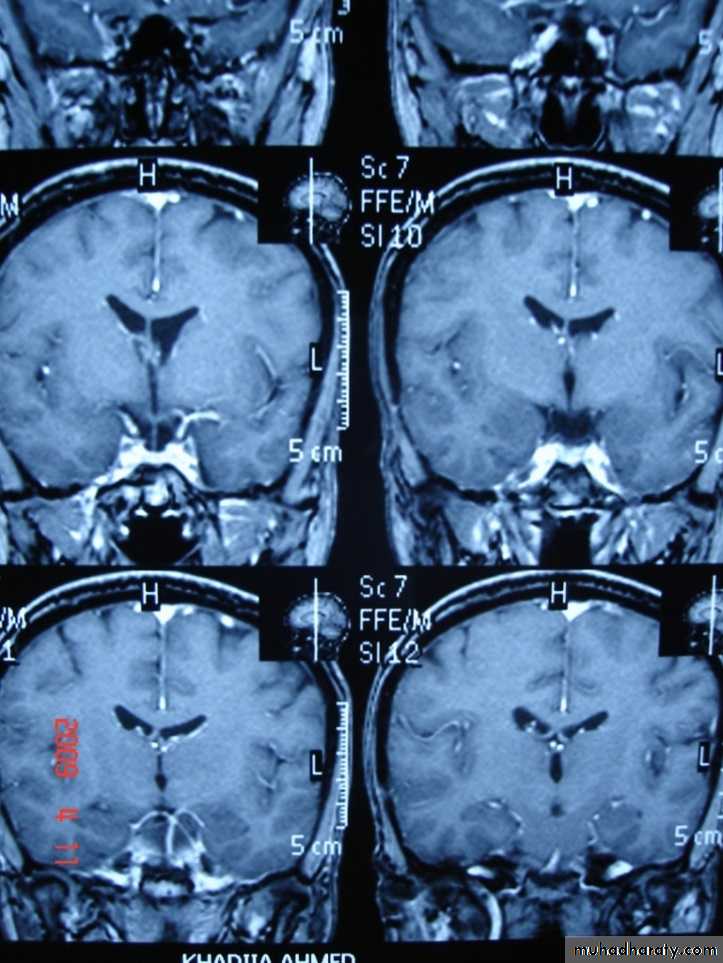 MRI
