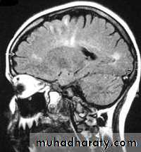 MRI