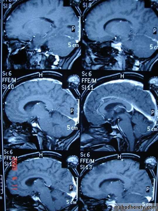 MRI