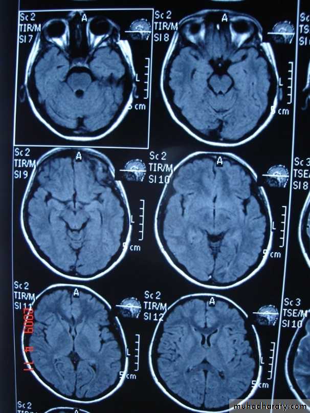 MRI