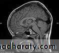 MRI