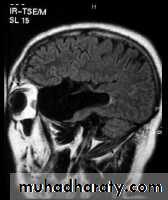 MRI