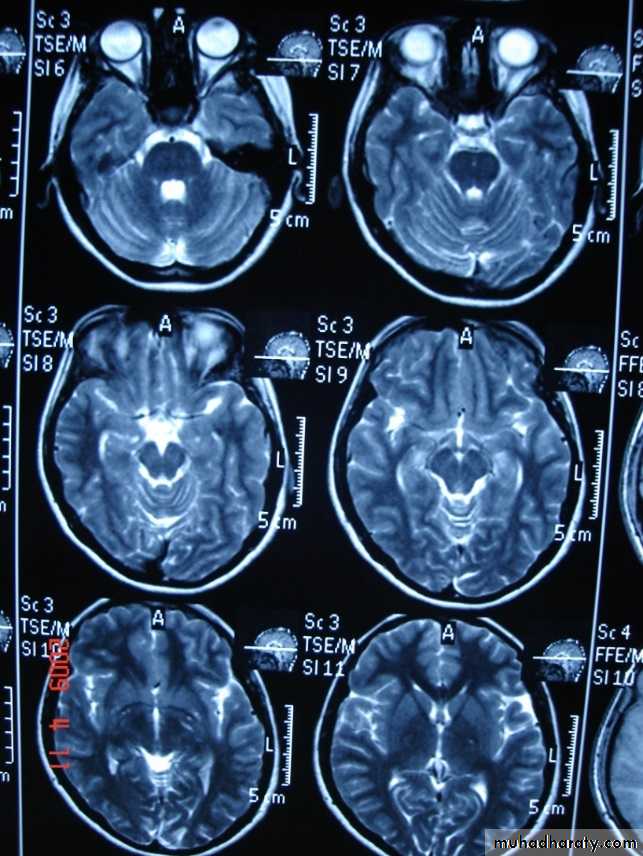 MRI