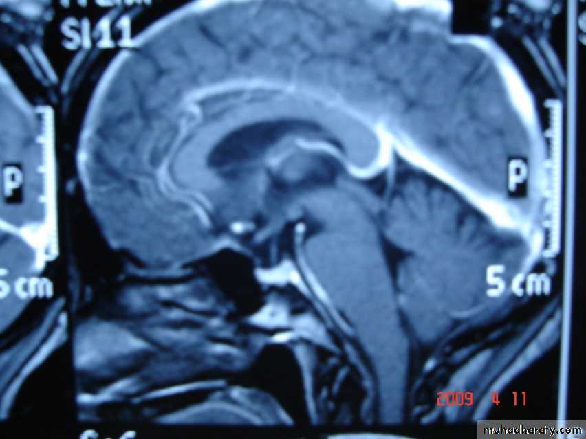 MRI