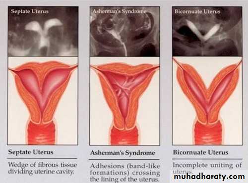 begnin uterus