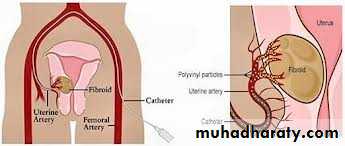 begnin uterus
