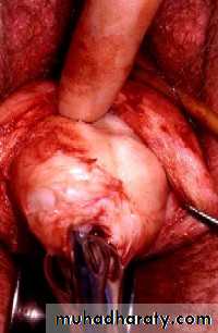 begnin uterus