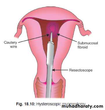 begnin uterus