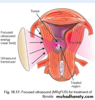 begnin uterus