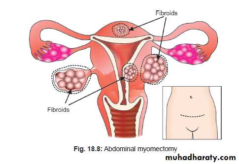 begnin uterus