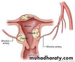 begnin uterus