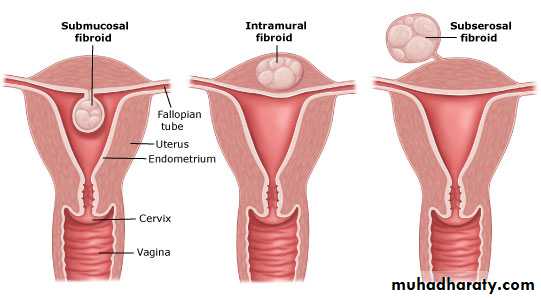 begnin uterus