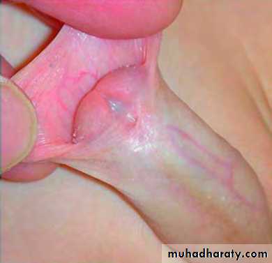 Urethra inury and hypospadias final