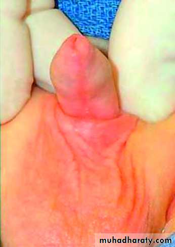 Urethra inury and hypospadias final