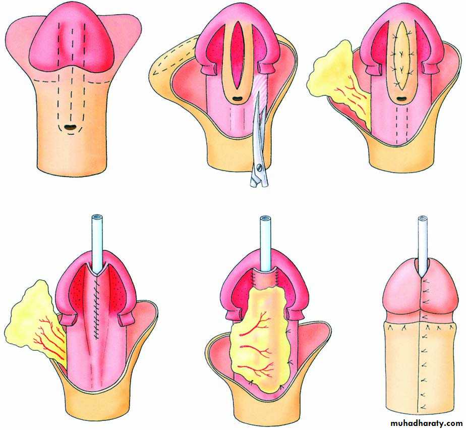 Urethra inury and hypospadias final