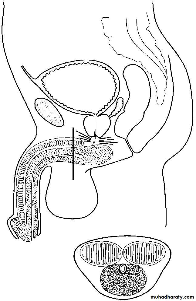 Urethra inury and hypospadias final