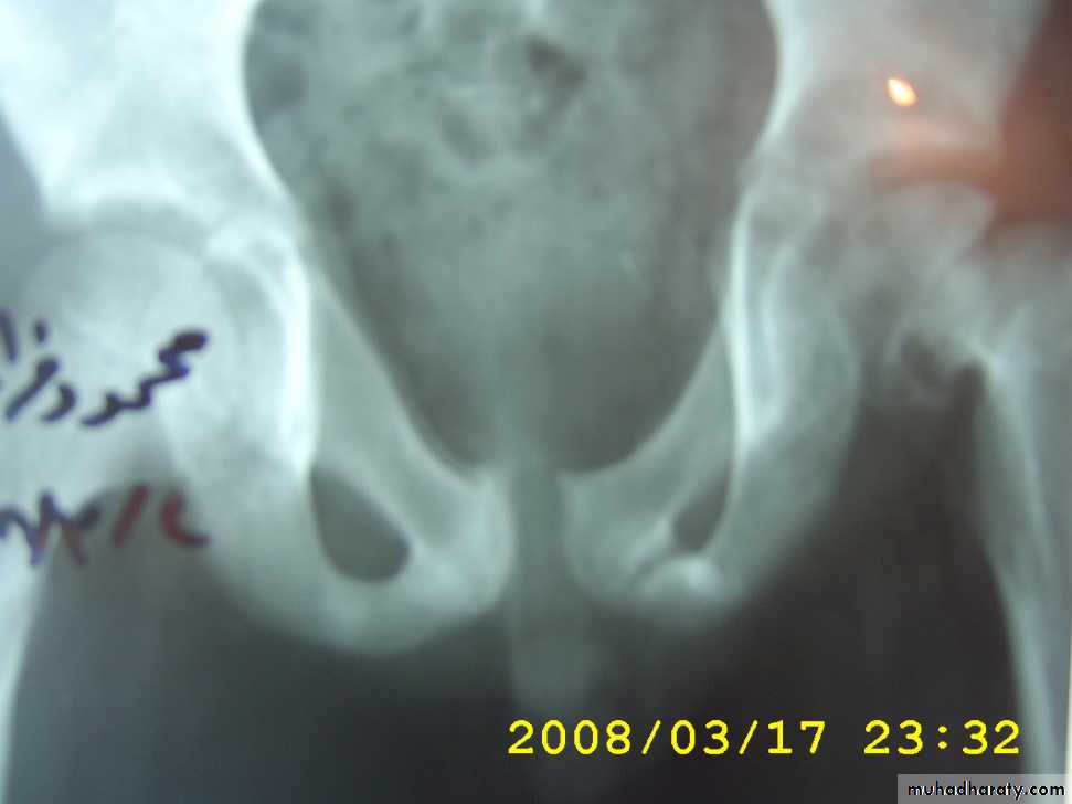 Urethra inury and hypospadias final