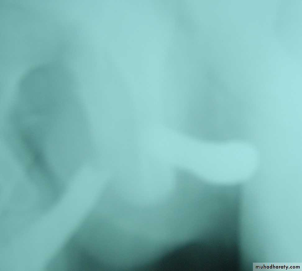 Urethra inury and hypospadias final