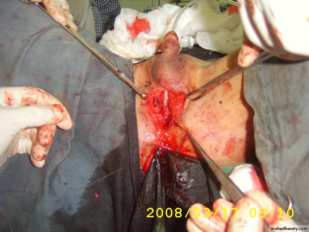 Urethra inury and hypospadias final
