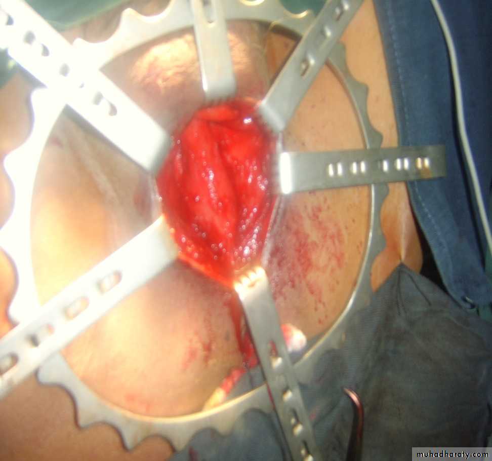Urethra inury and hypospadias final