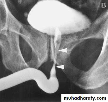 Urethra inury and hypospadias final