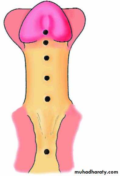 Urethra inury and hypospadias final