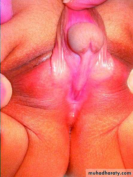 Urethra inury and hypospadias final