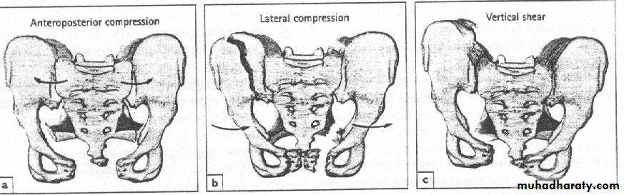 pelvic fracture