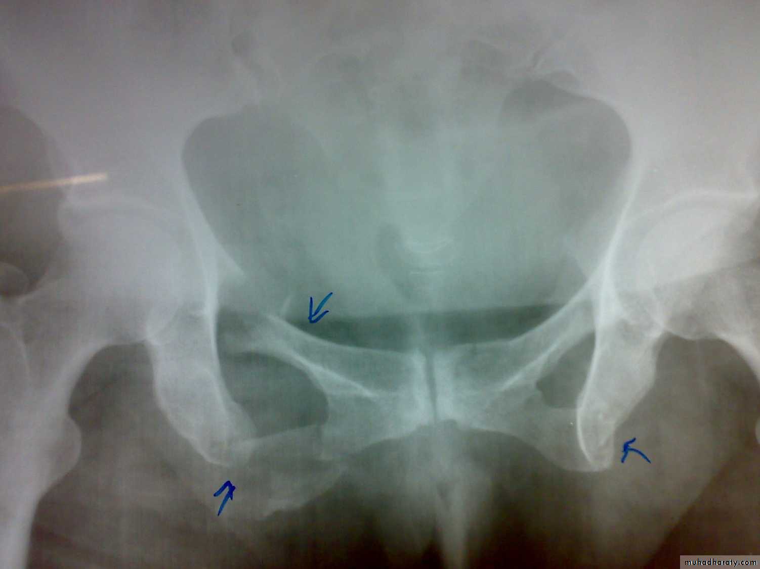 pelvic fracture