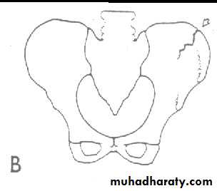 pelvic fracture