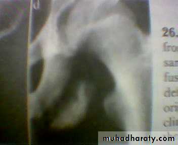 pelvic fracture