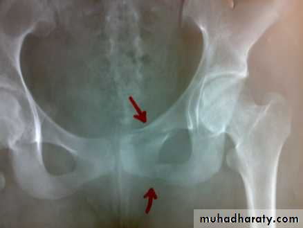 pelvic fracture