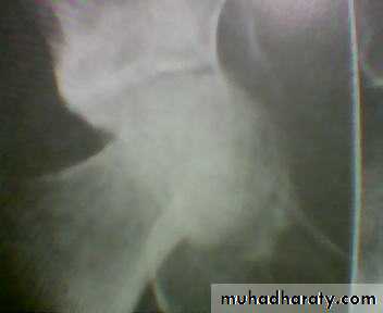 pelvic fracture