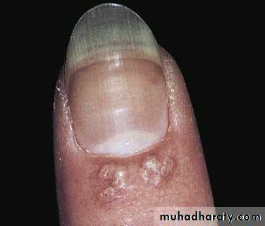 NailDiseases