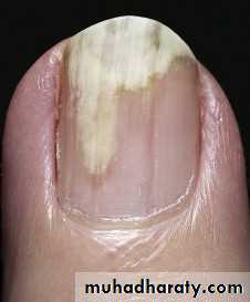NailDiseases