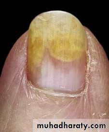 NailDiseases