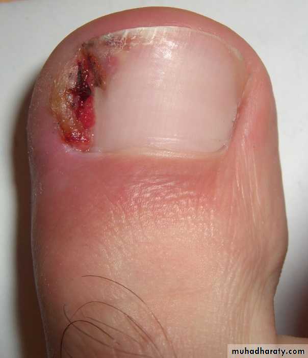 NailDiseases