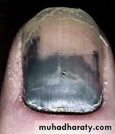 NailDiseases