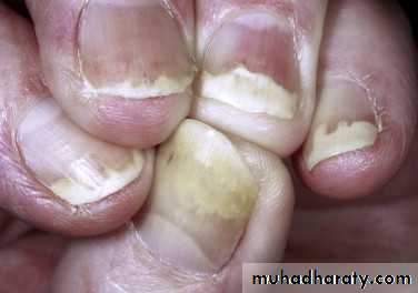 NailDiseases