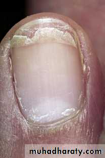 NailDiseases
